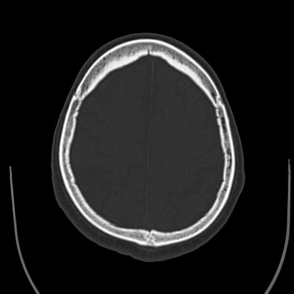 File:Brain Pantopaque remnants (Radiopaedia 78403-91048 Axial bone window 52).jpg