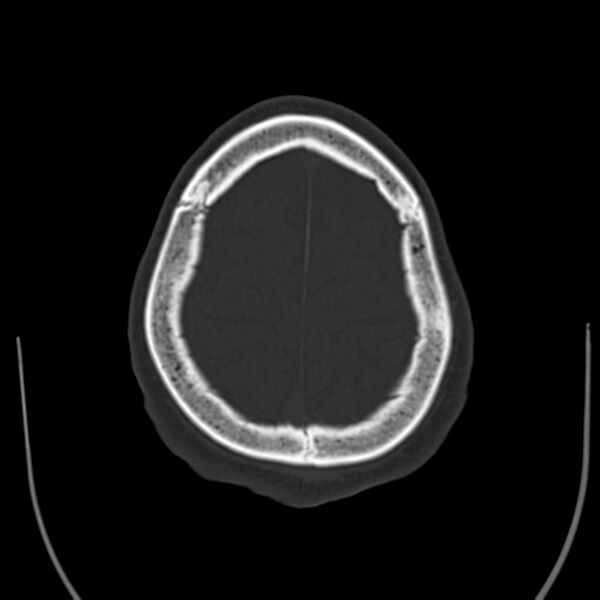 File:Brain Pantopaque remnants (Radiopaedia 78403-91048 Axial bone window 58).jpg