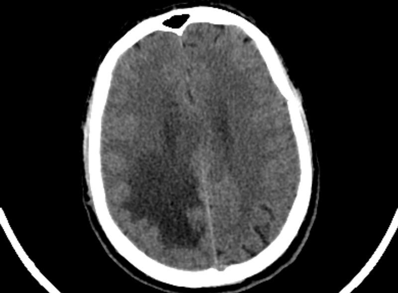 File:Brain abscess complicated by intraventricular rupture and ventriculitis (Radiopaedia 82434-96575 Axial non-contrast 78).jpg