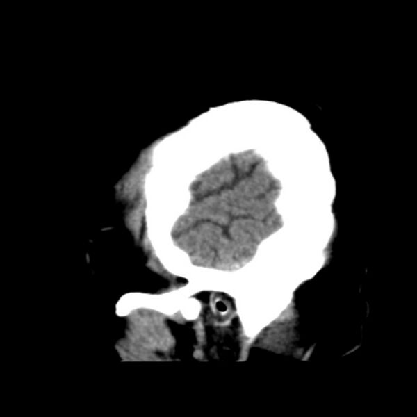File:Brain cortical laminar necrosis (Radiopaedia 25822-25971 non-contrast 6).jpg
