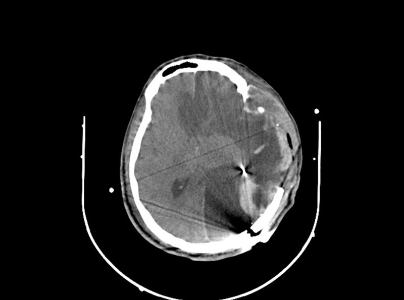 File:Brain injury by firearm projectile (Radiopaedia 82068-96087 B 108).jpg