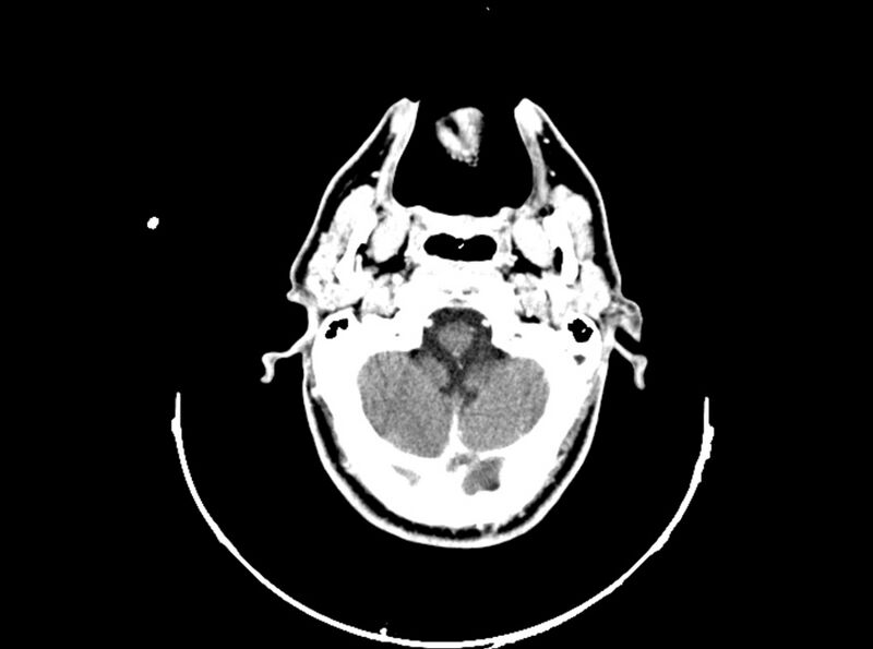File:Brain injury by firearm projectile (Radiopaedia 82068-96088 B 65).jpg