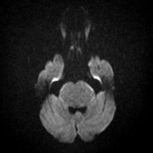 File:Brainstem glioma (Radiopaedia 5683-7390 Axial DWI 1).jpg