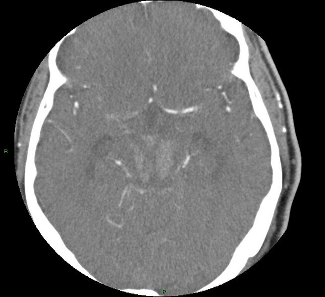 File:Brainstem hemorrhage (Radiopaedia 58794-66028 D 82).jpg