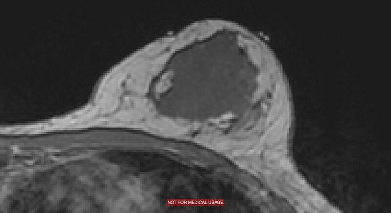 File:Breast lymphoma (MRI) (Radiopaedia 34999-36498 Axial T1 8).jpg