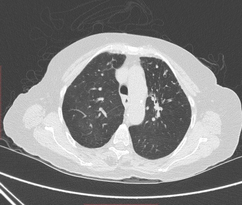 Bronchiectasis (Radiopaedia 72693-83293 Axial lung window 35).jpg