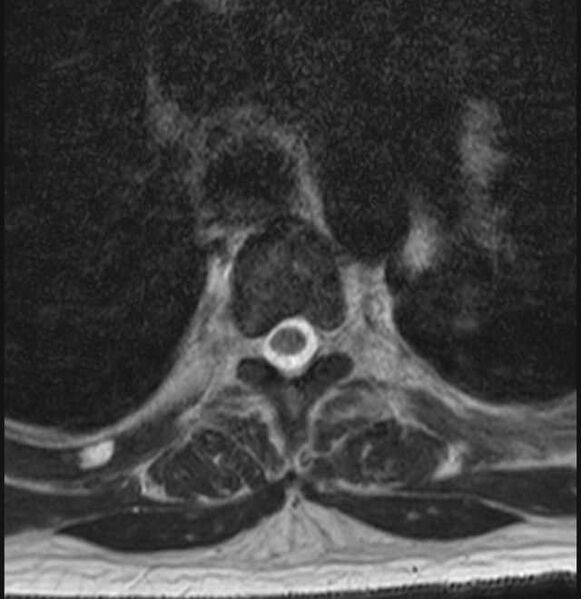 File:Brown tumors compressing the spinal cord (Radiopaedia 68442-78030 A 39).jpg