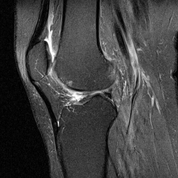 File:Bucket handle tear - medial meniscus (Radiopaedia 79028-91942 Sagittal PD fat sat 10).jpg