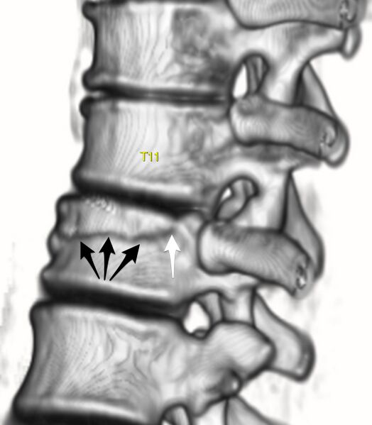 File:Bulging of paraspinal line in traumatic thoracal spinal compression fracture (Radiopaedia 29221-29619 3D VR 1).jpg