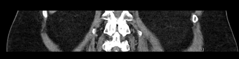 File:Buried bumper syndrome - gastrostomy tube (Radiopaedia 63843-72575 Coronal Inject 80).jpg