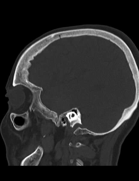File:Burnt-out meningioma (Radiopaedia 51557-57337 Sagittal bone window 12).jpg