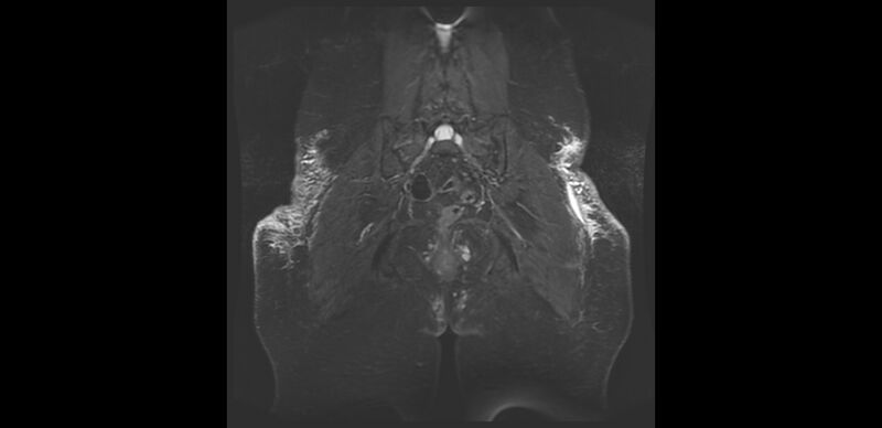 File:Buttock filler complications (Radiopaedia 63497-72115 Coronal STIR 18).jpg