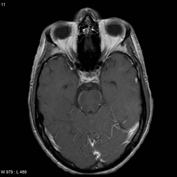 File:CMV ventriculitis and encephalitis (Radiopaedia 5416-7166 Axial T1 C+ 2).jpg