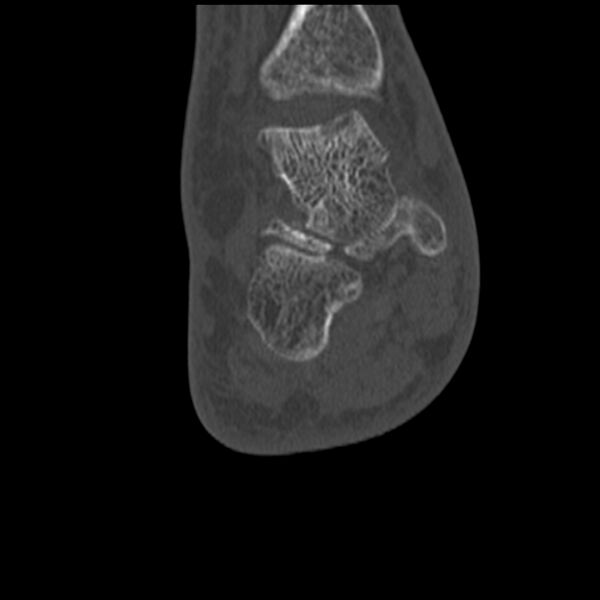 File:Calcaneal tuberosity avulsion fracture (Radiopaedia 22649-22668 Coronal bone window 45).jpg