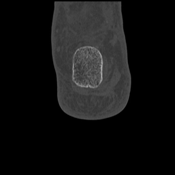 File:Calcaneal tuberosity avulsion fracture (Radiopaedia 22649-22668 Coronal bone window 60).jpg
