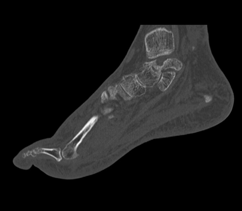 Calcaneal tuberosity avulsion fracture (Radiopaedia 22649-22668 Sagittal bone window 32).jpg