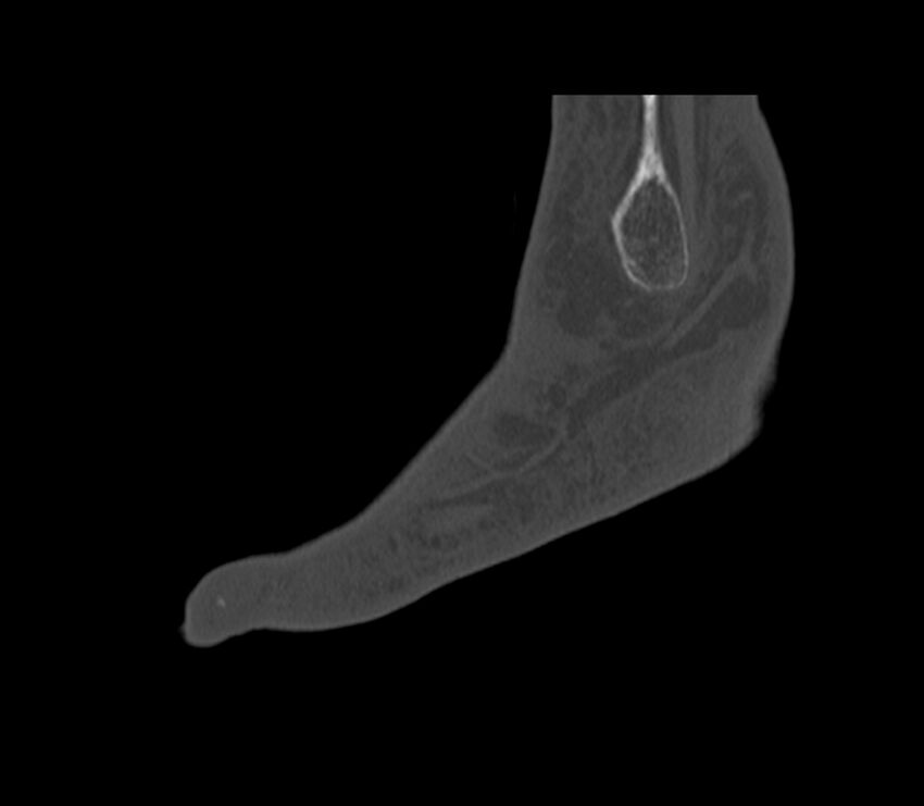 Calcaneal tuberosity avulsion fracture (Radiopaedia 22649-22668 Sagittal bone window 4).jpg