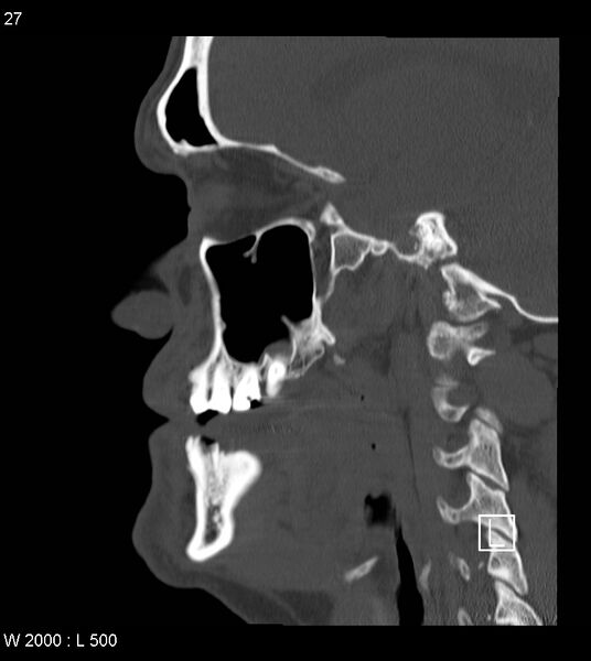 File:Calcification of the transverse band of the cruciform ligament (Radiopaedia 53063-59025 Sagittal bone window 4).jpg