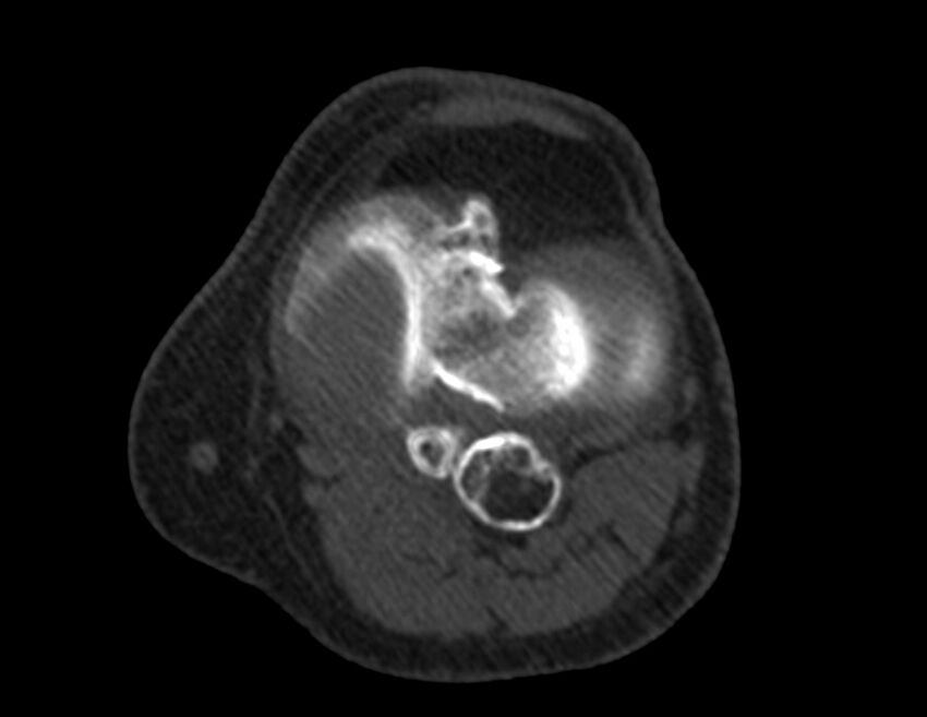 Calcified hematoma - popliteal fossa (Radiopaedia 63938-72763 Axial bone window 29).jpg