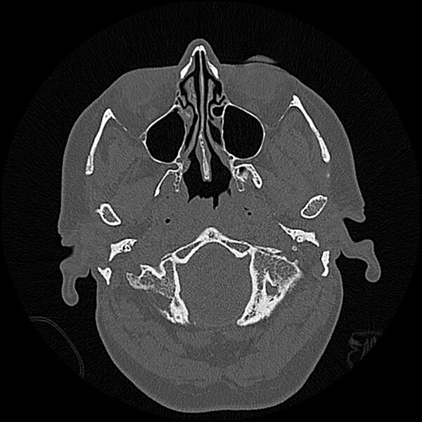 File:Canal up mastoidectomy (Radiopaedia 78108-90638 Axial bone window 19).jpg