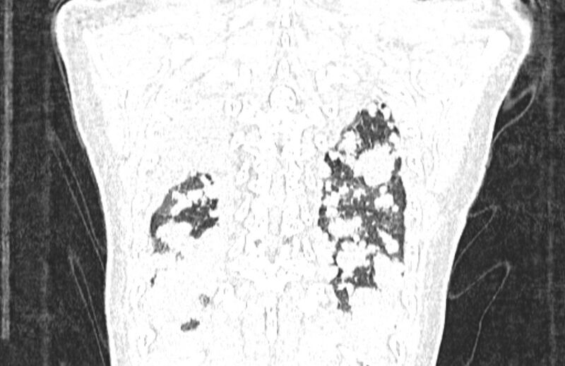 File:Cannonball metastases from breast cancer (Radiopaedia 91024-108569 Coronal lung window 130).jpg