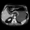 Carcinoma of the stomach (Radiopaedia 8938).jpg