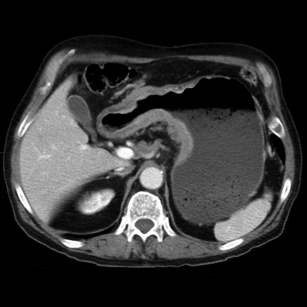 File:Carcinoma of the stomach (Radiopaedia 8938).jpg