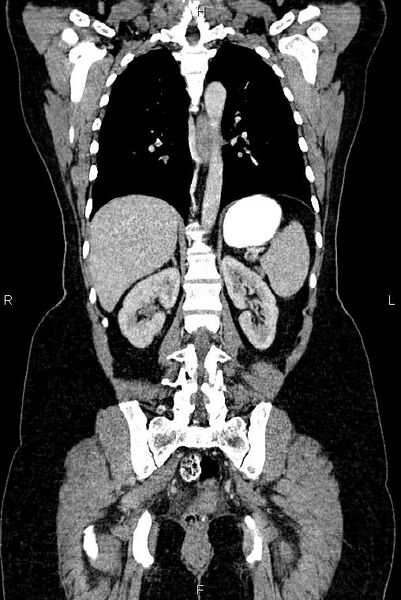 File:Carcinoma of uterine cervix (Radiopaedia 85861-101700 C 39).jpg