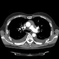 Cardiac tamponade (Radiopaedia 78607-91368 Axial C+ CTPA 30).jpg