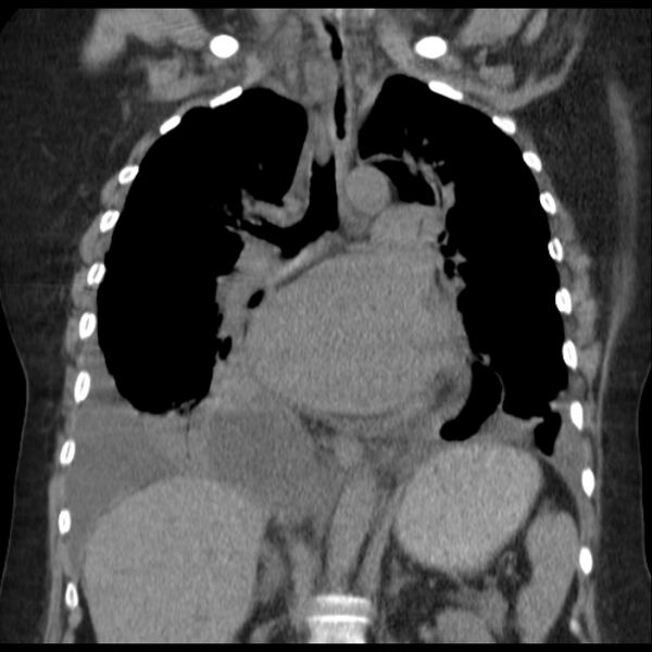 File:Cardiogenic pulmonary edema (Radiopaedia 29213-29609 Coronal non-contrast 23).jpg