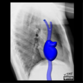 Cardiomediastinal anatomy on chest radiography (annotated images) (Radiopaedia 46331-50748 C 1).png