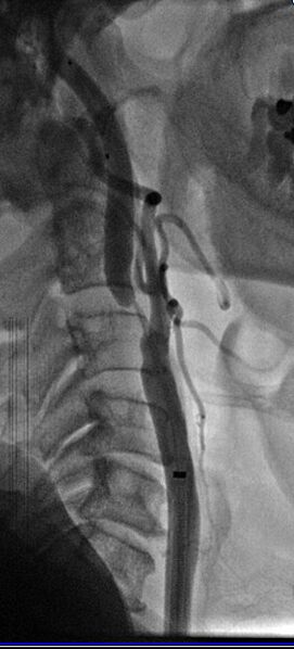 File:Carotid angioplasty (Radiopaedia 16766-16479 A 1).jpg