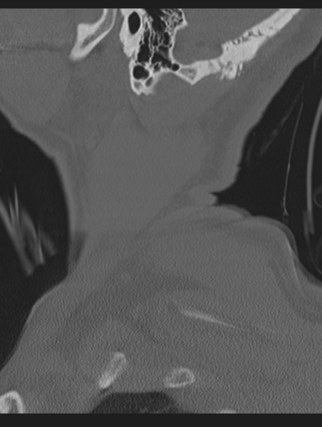 File:Cavernoma of cervical cord (Radiopaedia 50838-56346 Sagittal bone window 3).png