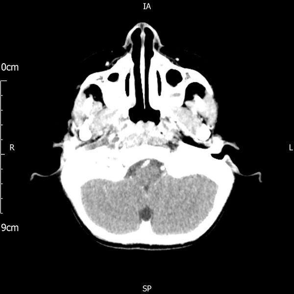 File:Cavernous sinus thrombosis (Radiopaedia 79414-92510 Axial Brain 54).jpg