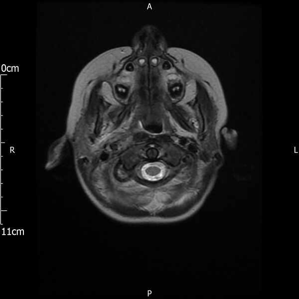 File:Cavernous sinus thrombosis (Radiopaedia 79414-92512 Axial T2 1).jpg