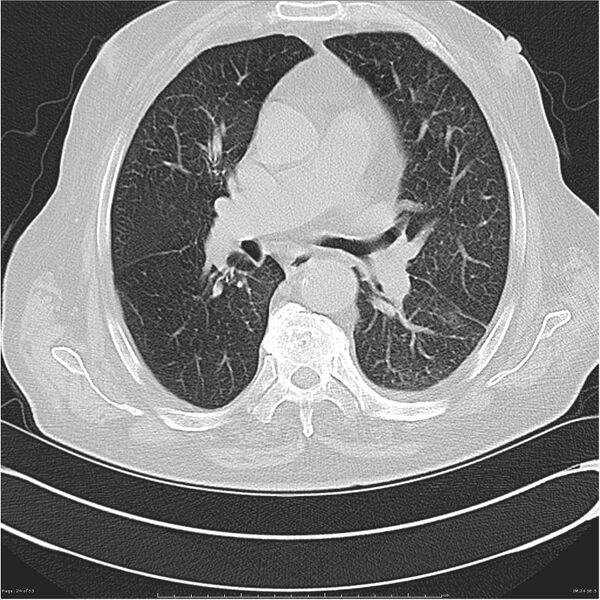 File:Cavitating left lower lobe lesion - squamous cell lung cancer (Radiopaedia 27749-28176 Axial lung window 24).jpg