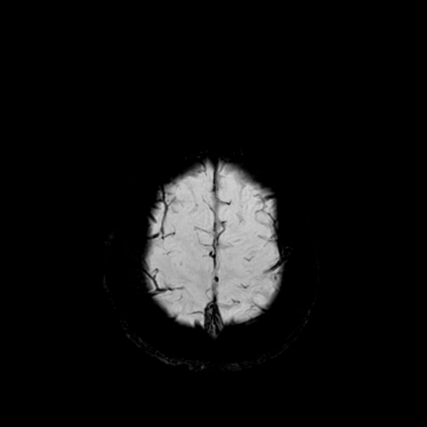 Central neurocytoma (Radiopaedia 79320-92380 Axial SWI 126).jpg