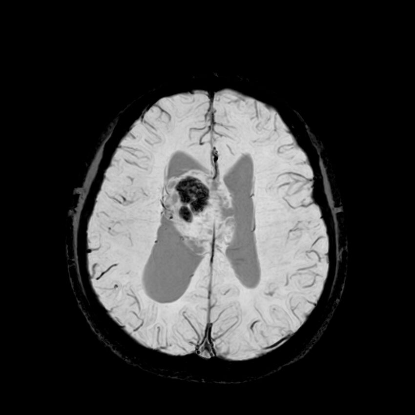 Central neurocytoma (Radiopaedia 79320-92380 Axial SWI 95).jpg
