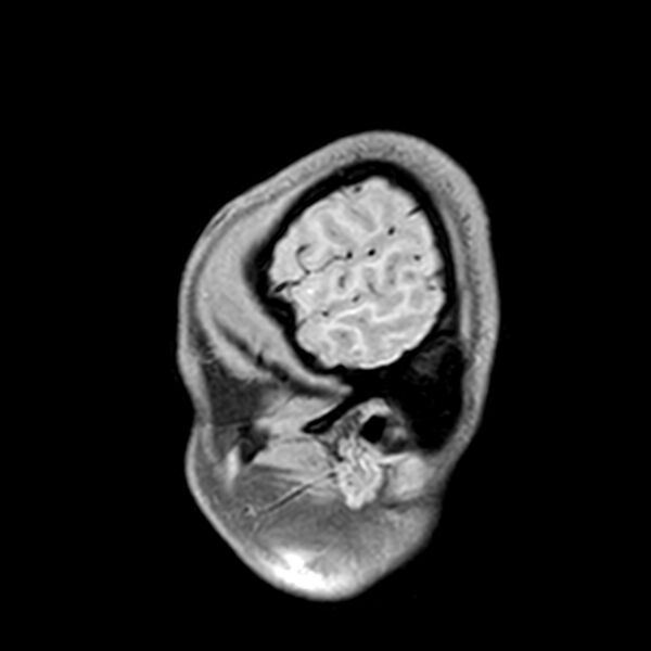 File:Central neurocytoma (Radiopaedia 79320-92380 Sagittal T1 30).jpg