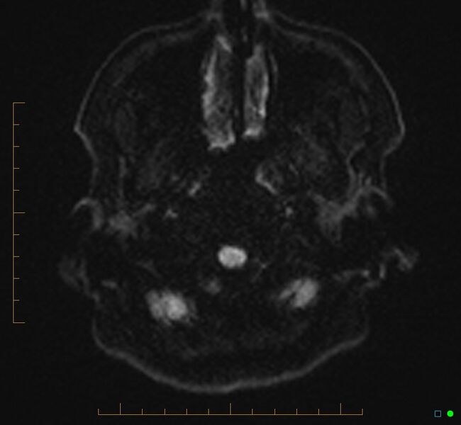 File:Cerebellar gangliocytoma (Radiopaedia 65377-74422 Axial DWI 2).jpg