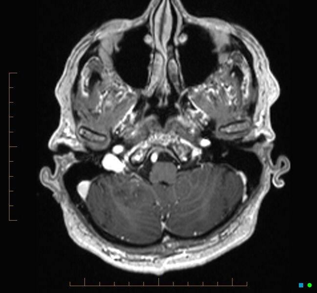File:Cerebellar gangliocytoma (Radiopaedia 65377-74422 Axial T1 C+ 14).jpg