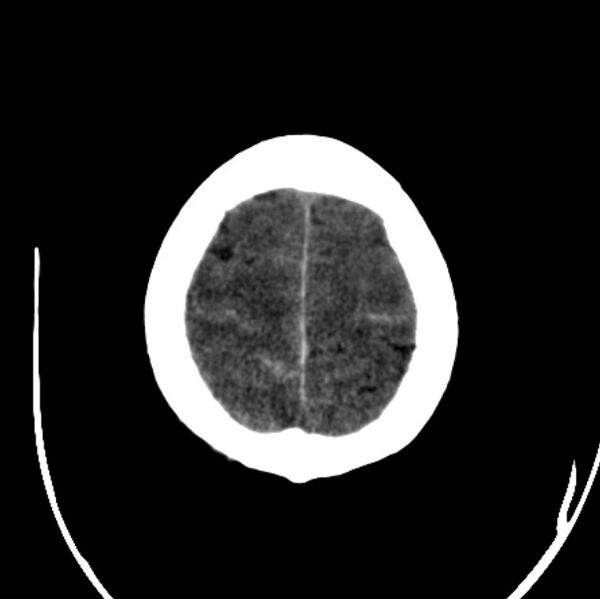 File:Cerebellar hemorrhage causing obstructive hydrocephalus (Radiopaedia 33989-35207 Axial non-contrast 45).jpg