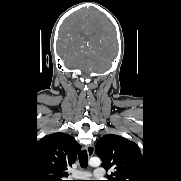 File:Cerebellar infarct due to vertebral artery dissection with posterior fossa decompression (Radiopaedia 82779-97029 D 41).png