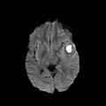 Cerebral abscess post cardiac surgery (Radiopaedia 27244-27420 Axial DWI 9).jpg