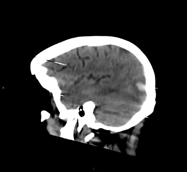 File:Cerebral amyloid angiopathy-associated lobar intracerebral hemorrhage (Radiopaedia 58377-65514 B 12).jpg