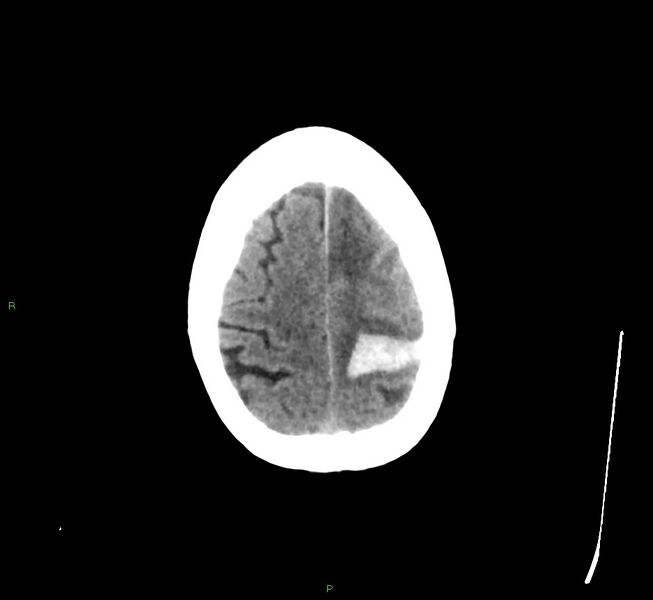 File:Cerebral amyloid angiopathy-associated lobar intracerebral hemorrhage (Radiopaedia 58529-65681 Axial non-contrast 9).jpg