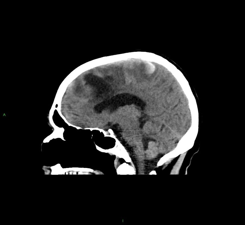 Cerebral amyloid angiopathy-associated lobar intracerebral hemorrhage (Radiopaedia 58529-65681 B 27).jpg