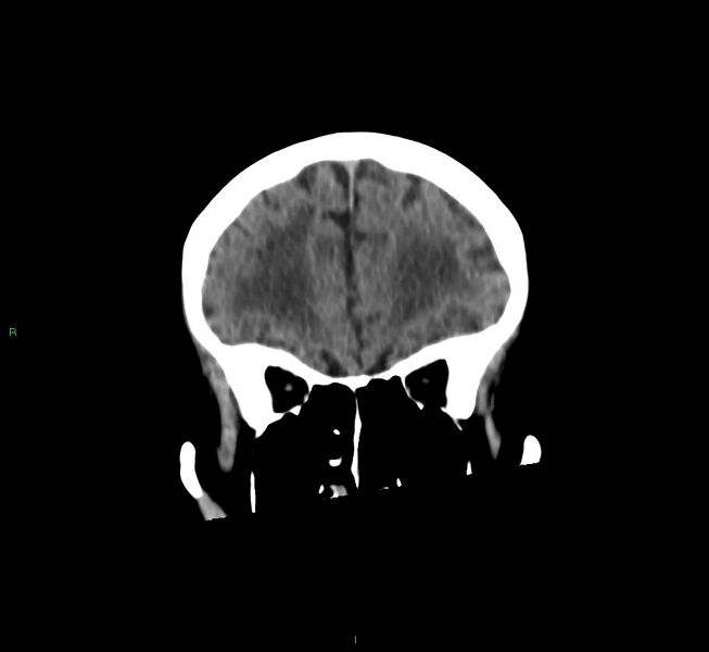 File:Cerebral amyloid angiopathy-associated lobar intracerebral hemorrhage (Radiopaedia 58530-65688 Coronal non-contrast 51).jpg