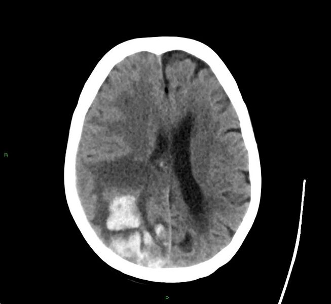File:Cerebral amyloid angiopathy-associated lobar intracerebral hemorrhage (Radiopaedia 58563-65727 Axial non-contrast 23).jpg