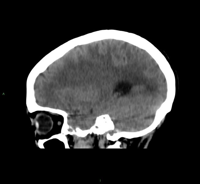 File:Cerebral amyloid angiopathy-associated lobar intracerebral hemorrhage (Radiopaedia 58566-65730 C 35).jpg